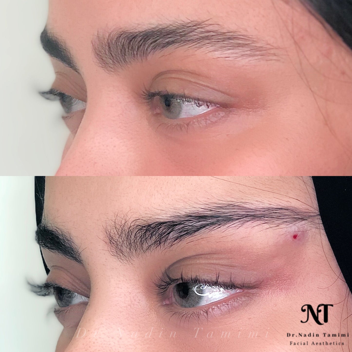 Fox eyes thread lift  1